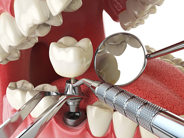 Best Emergency Root Canal Treatment in Etowah, TN